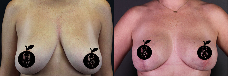 Breast Lift Patient 1 Front View
