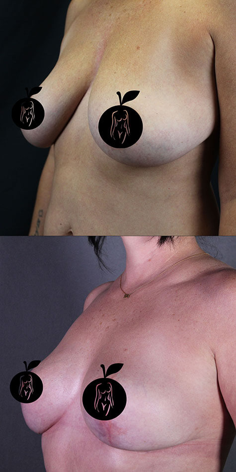 Breast Lift Patient 1 Side View
