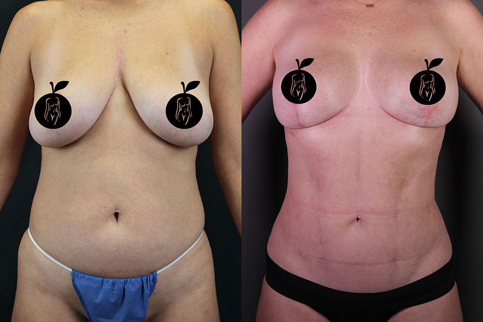 Breast Lift Patient 2 Front View