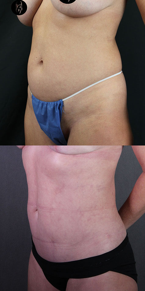 Liposuction Patient 1 Side View