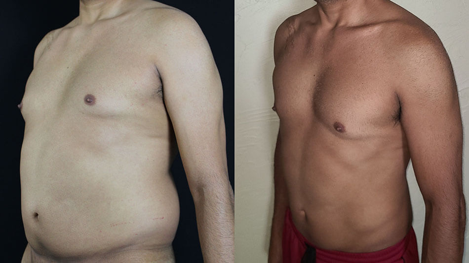 Liposuction Patient 3 Angle View