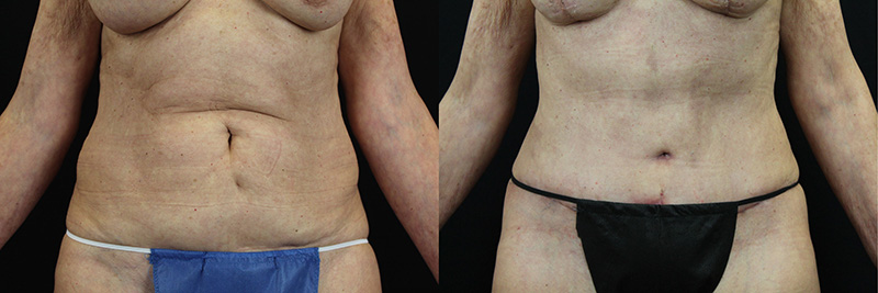 Tummy Tuck before and after 1