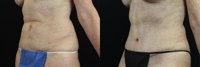 Tummy Tuck before and after 2