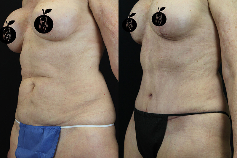 Tummy Tuck Patient 2 Results 2