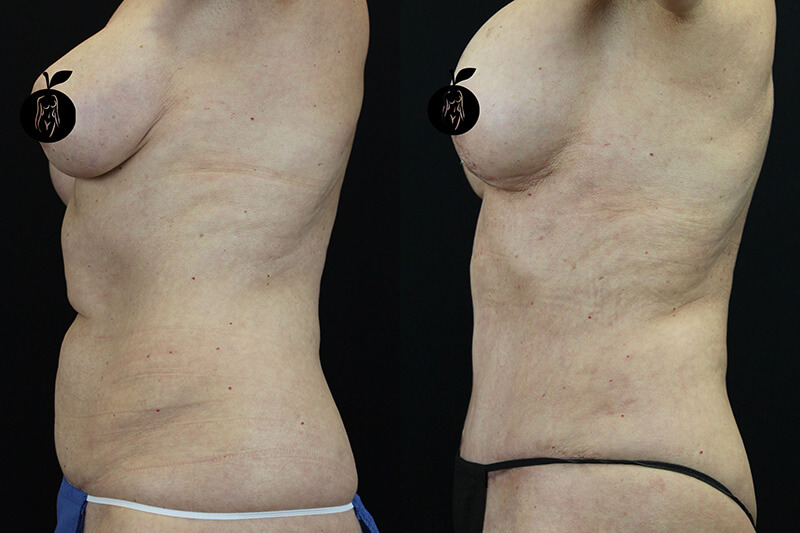 Tummy Tuck Patient 2 Results 3