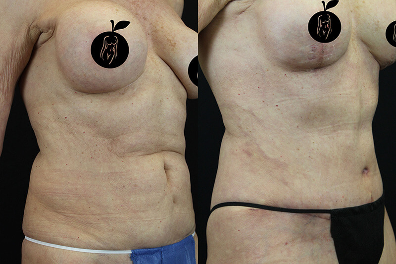 Tummy Tuck Patient 2 Results 4