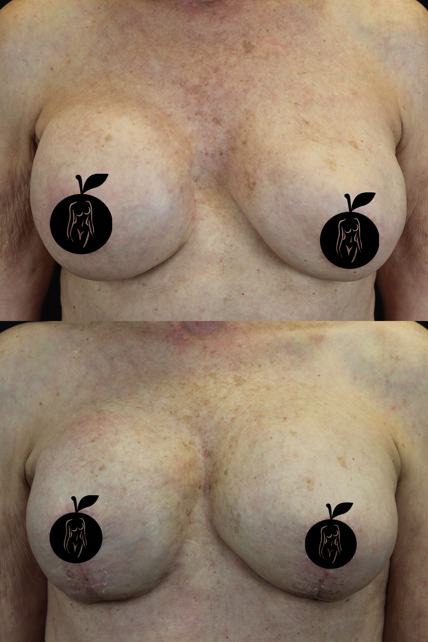 Breast Augmentation Patient Results 1