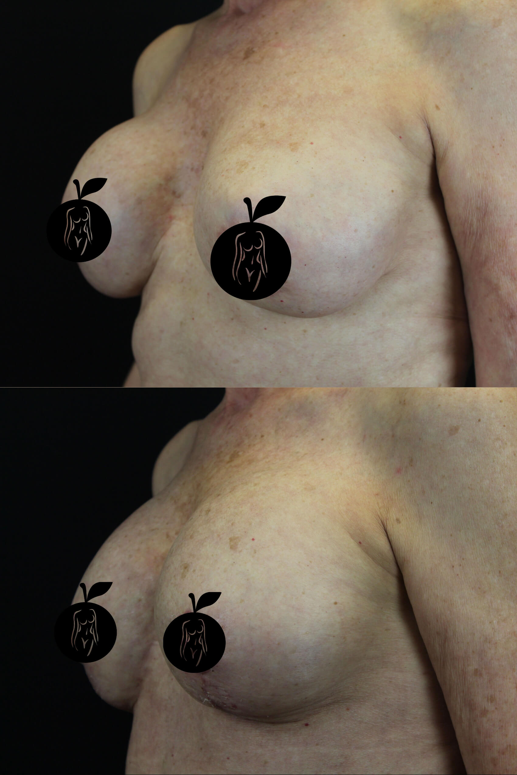 Breast Augmentation Patient Results 2