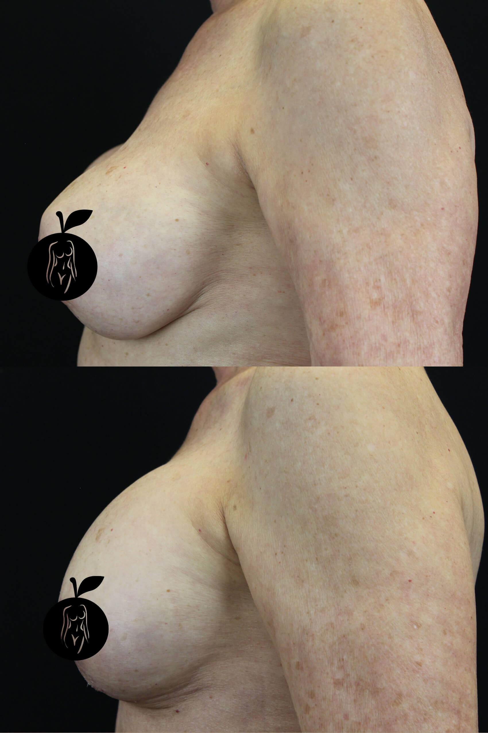 Breast Augmentation Patient Results 3
