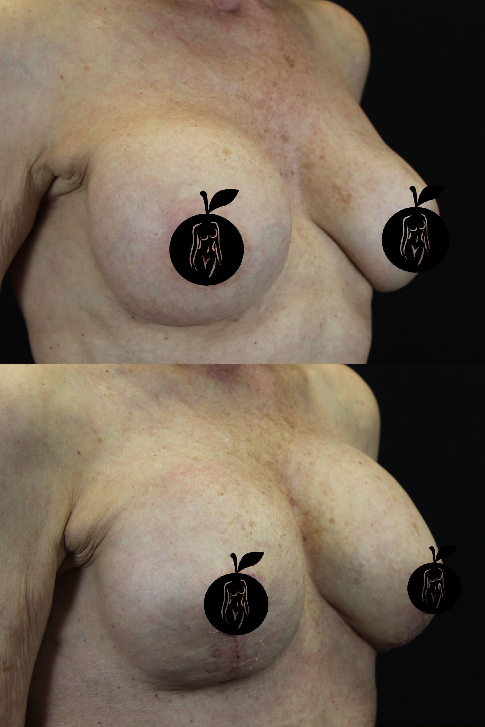 Breast Augmentation Patient Results 4