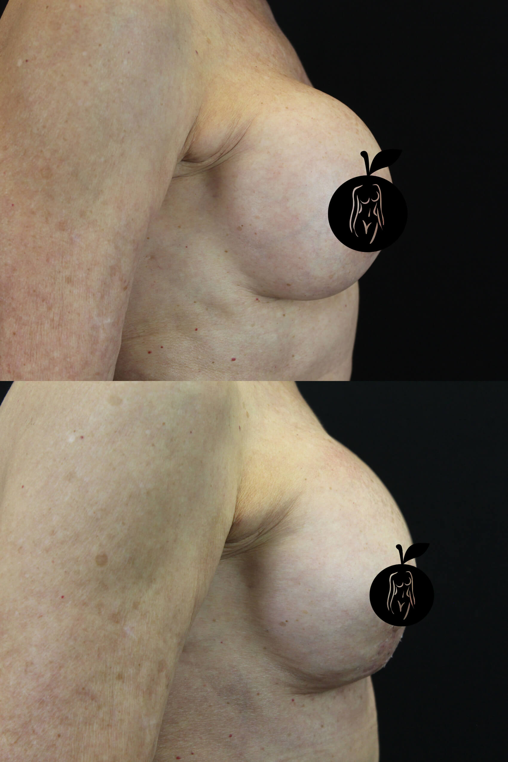 Breast Augmentation Patient Results 5