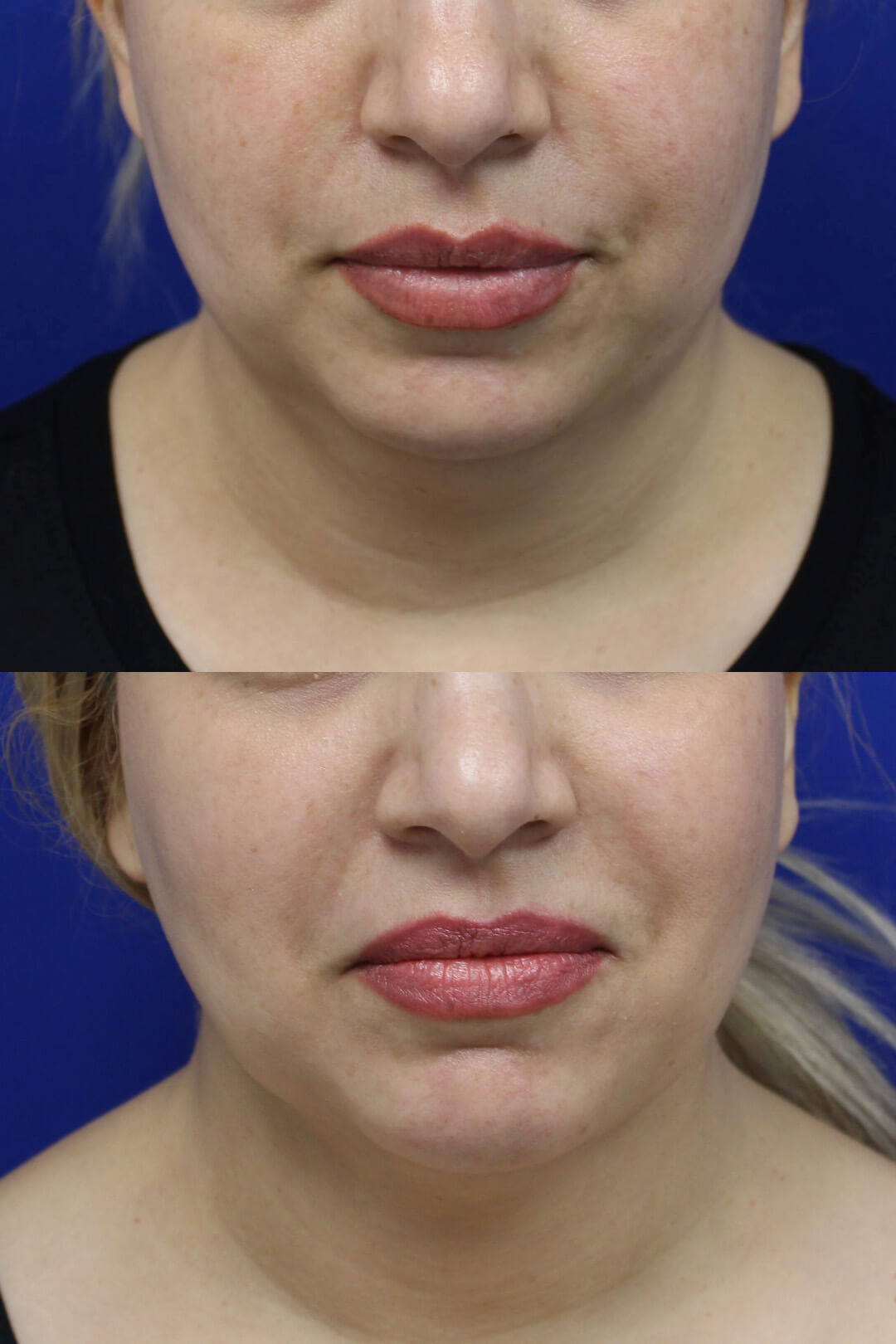 Buccal Fat Pad Removal Results 2