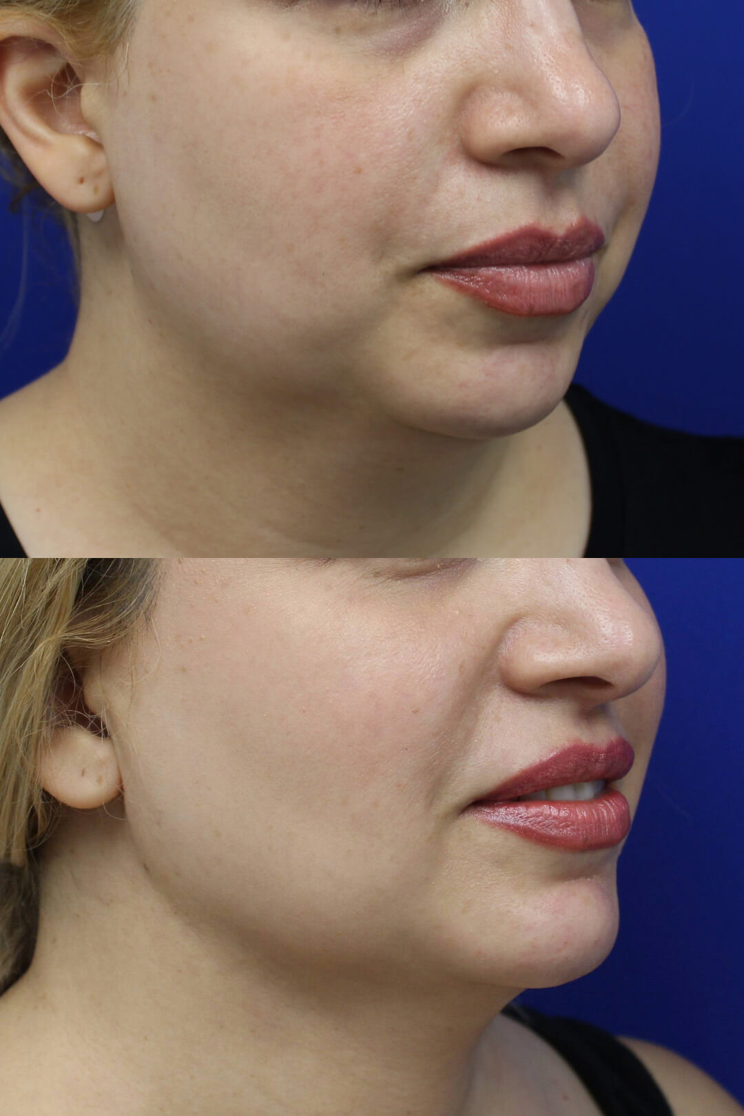Buccal Fat Pad Removal Results 3