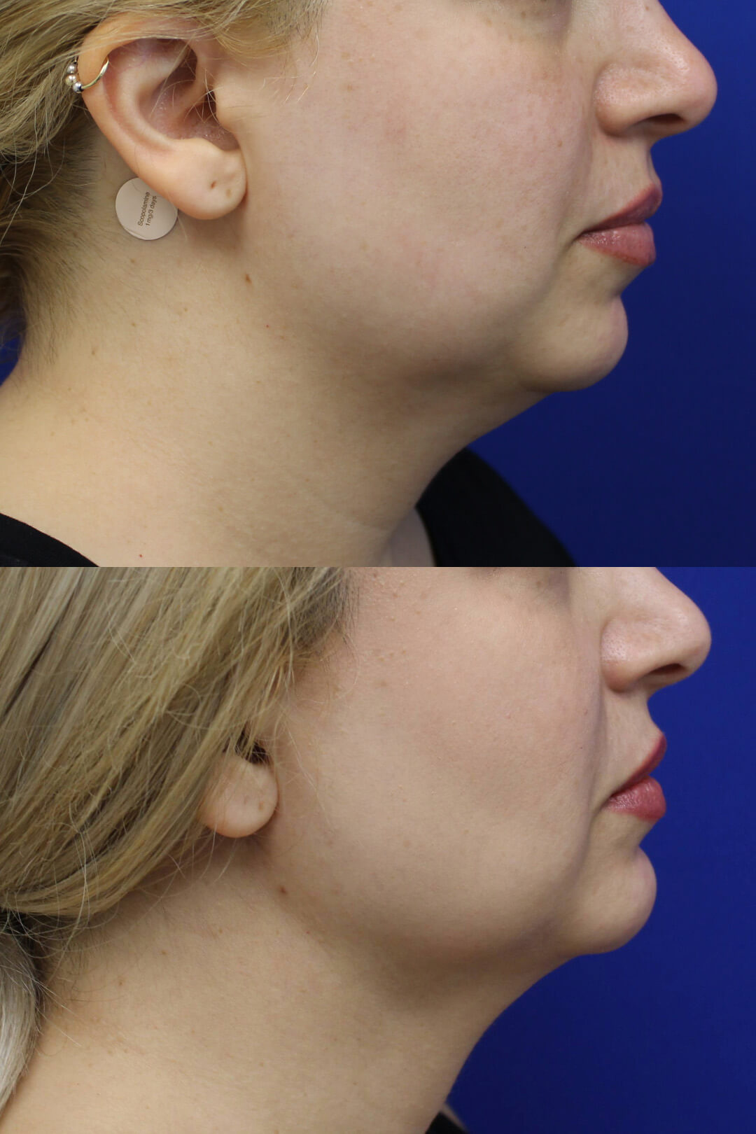 Buccal Fat Pad Removal Results 4