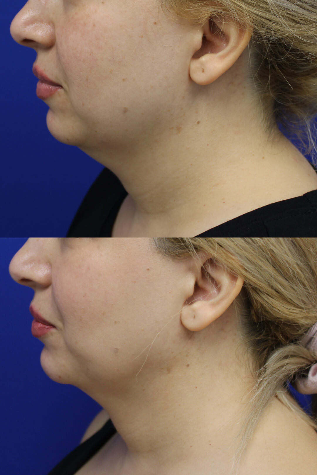 Buccal Fat Pad Removal Results 5