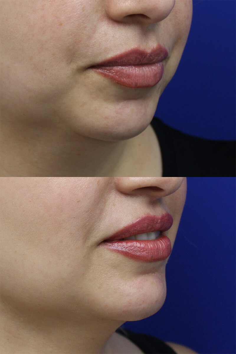 Chin Fillers Patient Results