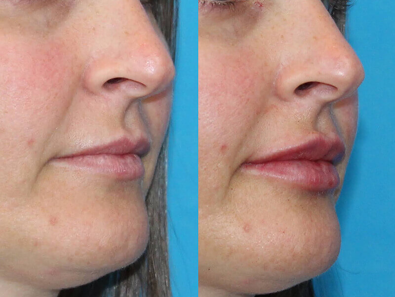 Lip Filler Patient 4 Results