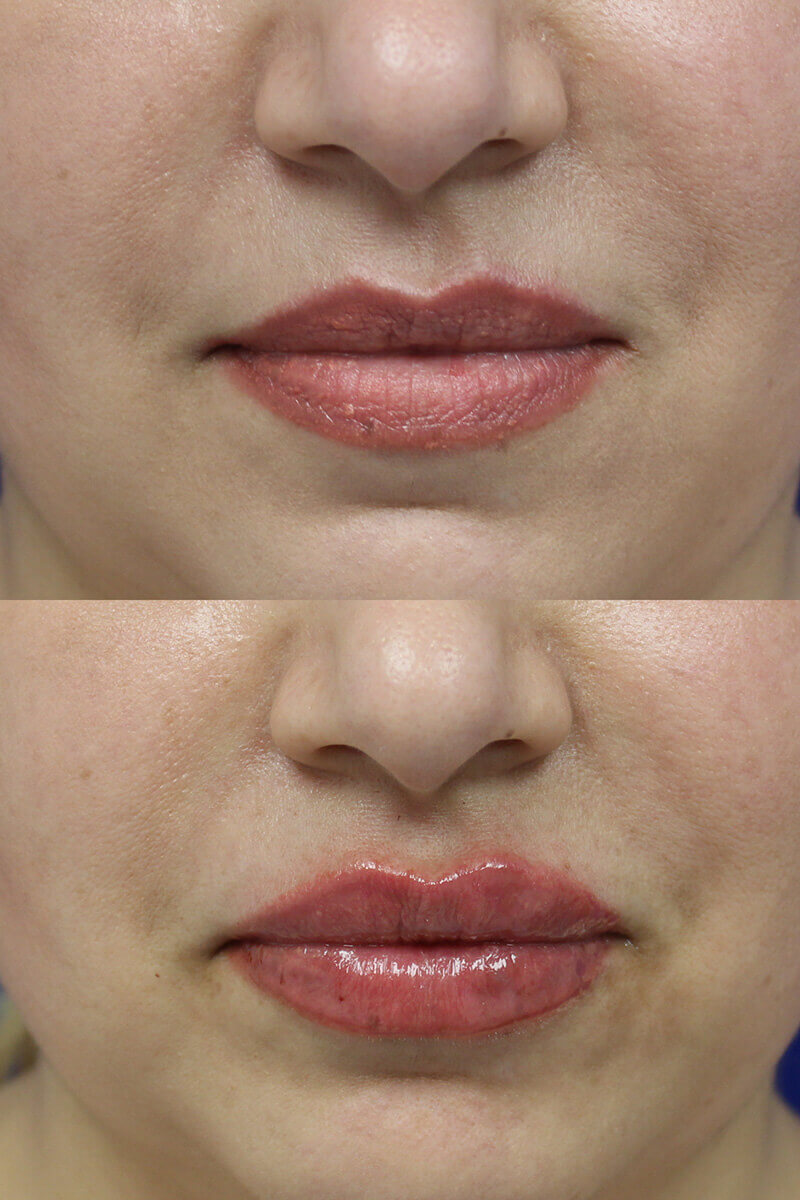 Lip Filler Patient 5 Results