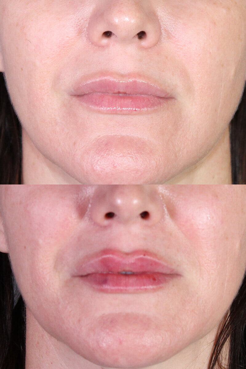 Lip Filler Patient 2 Results